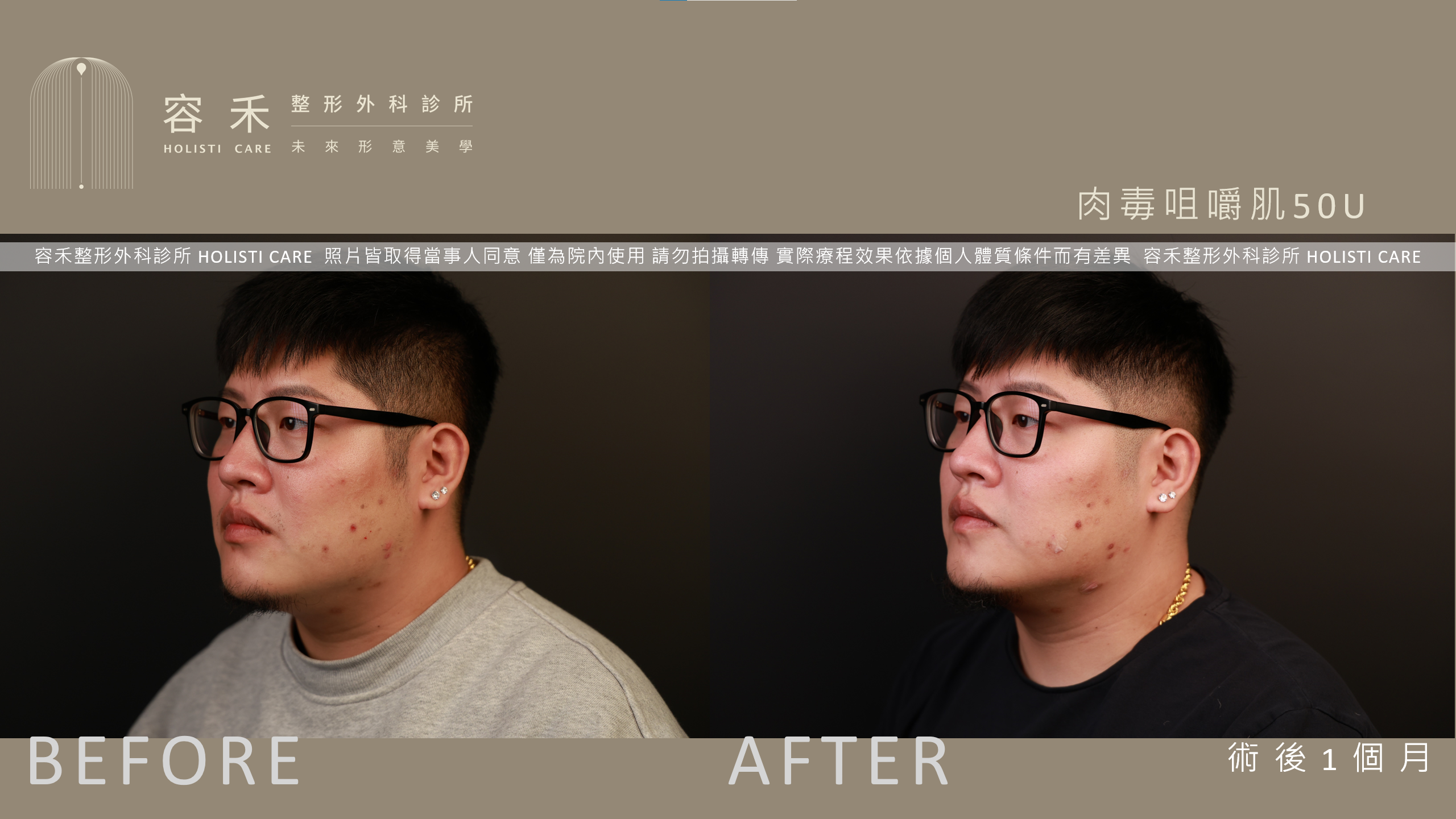 男性肉毒小臉案例