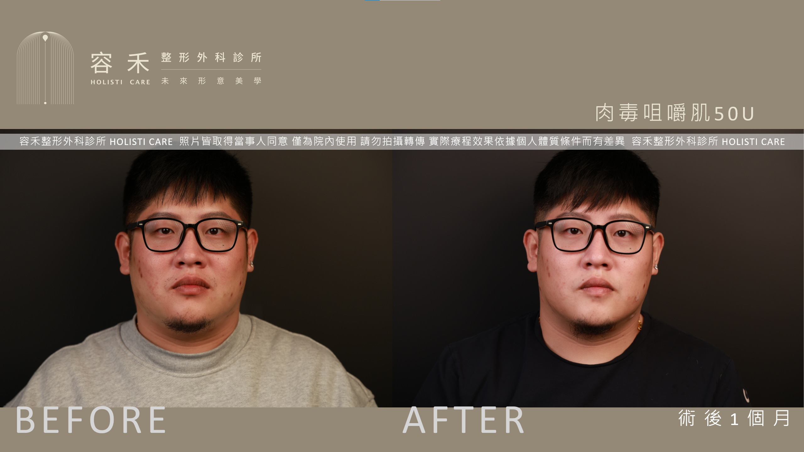 男性肉毒小臉案例