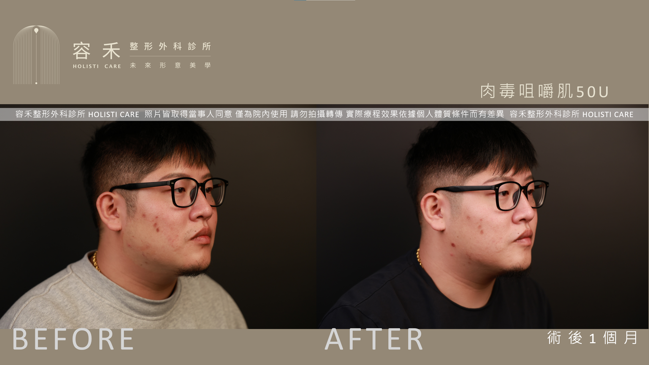 男性肉毒小臉案例