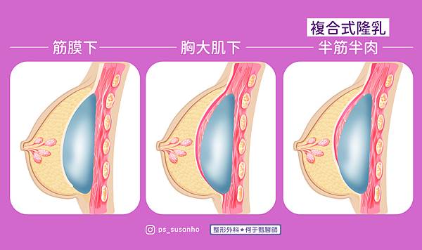 隆乳