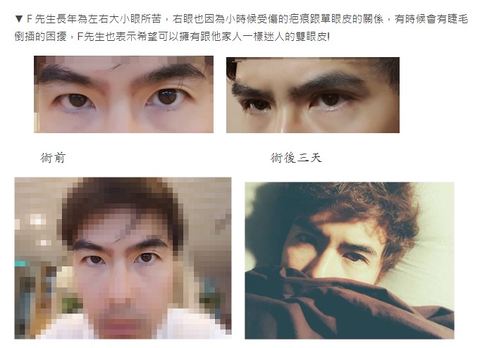 釘書機雙眼皮案例